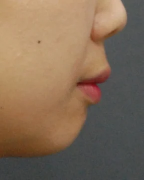 돌출입 치료 후 03-4 — 바른턱얼굴치과의원 실제 치료사례 비교 사진