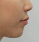돌출입 치료 후 04-4 — 바른턱얼굴치과의원 실제 치료사례 비교 사진