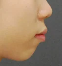 돌출입 치료 전 04-4 — 바른턱얼굴치과의원 실제 치료사례 비교 사진